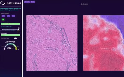 AI 助力脑瘤手术:10 秒内精准识别残留肿瘤