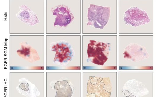 腾讯 AI 实现肺癌基因突变预测,精度最高 99%